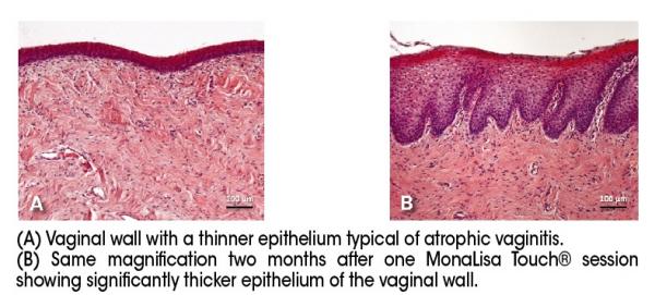 atrophic vaginal epithelium Hot sexy threesome video